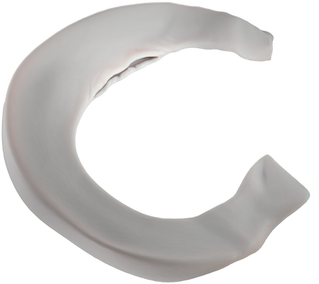 03_Horizontal_PreOp_Meniscus_01_01 2.png