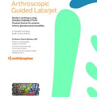 OSTEOCONNECT Arthroscopic Latarjet technique