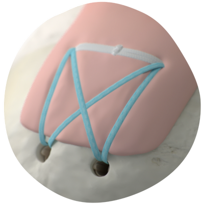 FullThicknessTear_HeroCutout(40062)_20250211