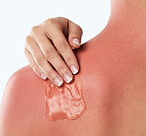 wound-information-sunburn.jpg