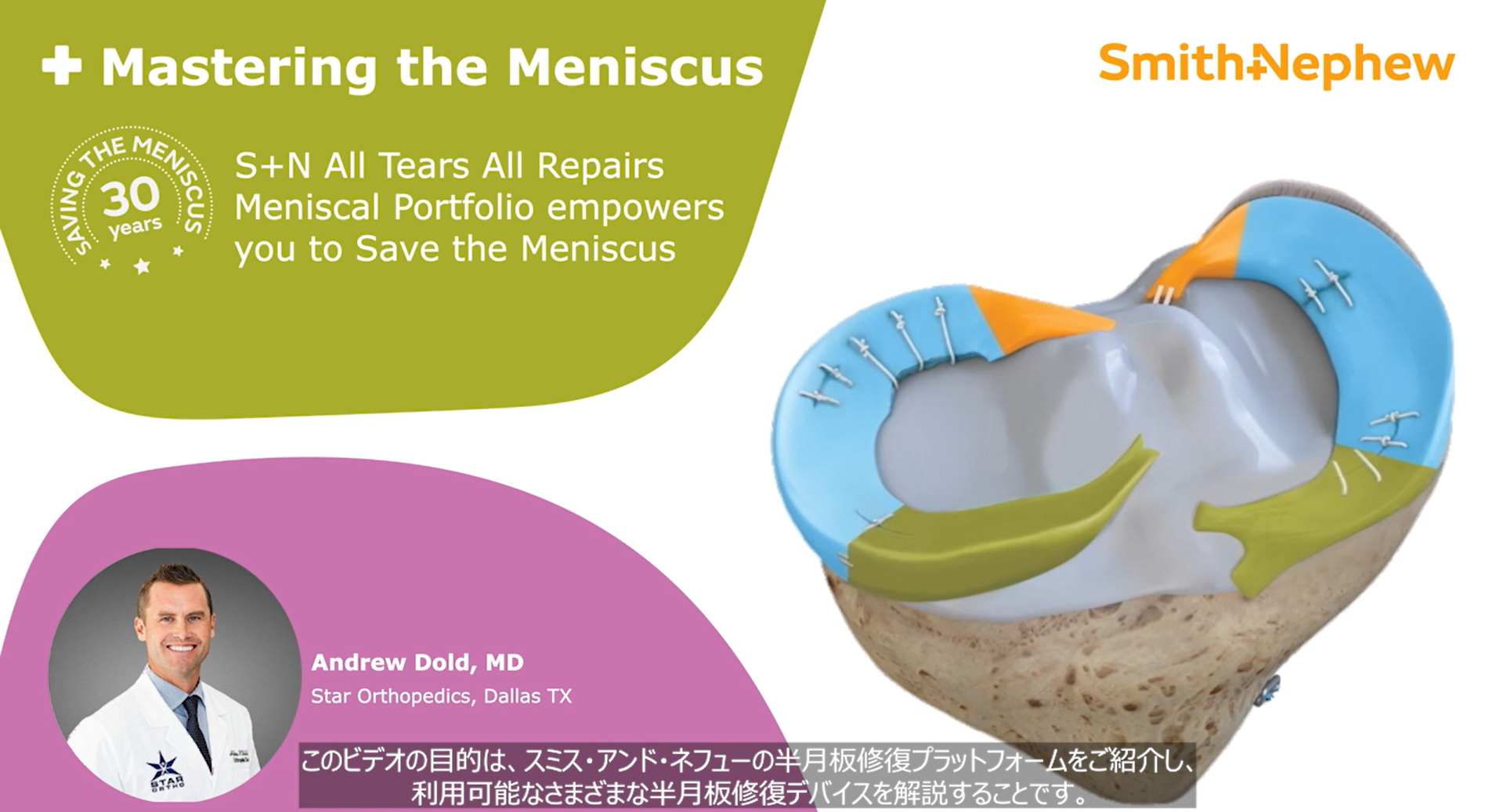 Mastering Meniscus.png