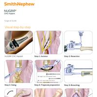 NUGRIP Surgical Guide
