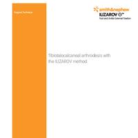 ILIZAROV Tibiotalocalcaneal Surgical Technique