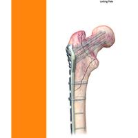 PERI-LOC PFP Surgical Technique