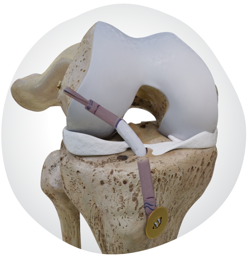 33747-V1-KNE-Ligament-Solutions.png