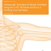 Surgical Technique: Arthroscopic Technique for Biceps Tenodesis Using the Q-FIX™ All-Suture Anchor in a Cinching Loop Technique