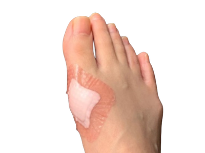 AWM_Bunion blister with AGBL.PNG