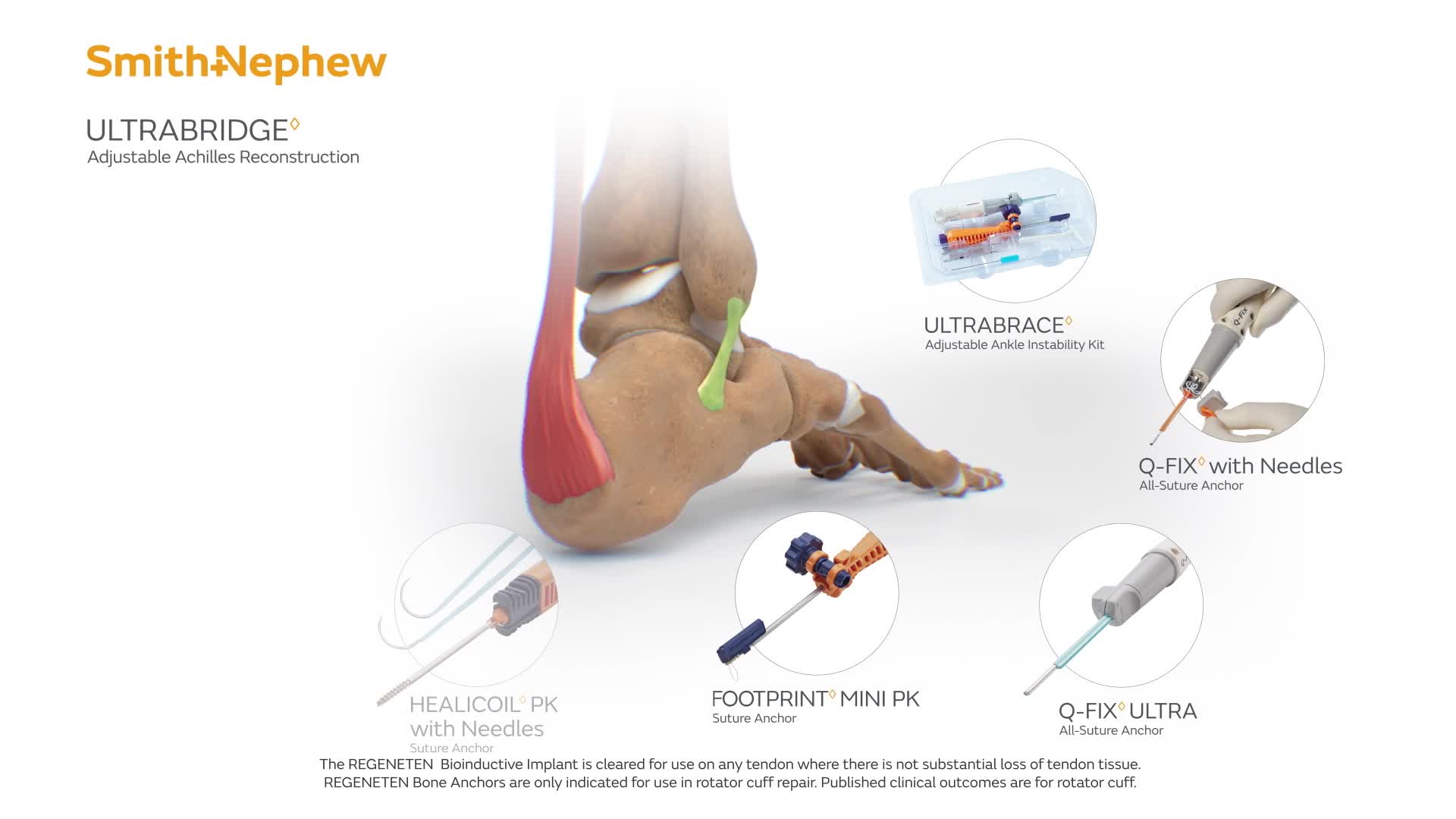 ULTRABRIDGE Achilles with REGENETEN Animation (NZ version)
