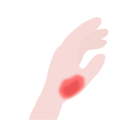 Icon - Consumer - First Degree Burns