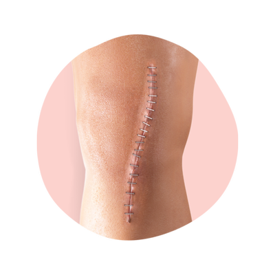 PICO Negative Pressure Wound Therapy Surgical Incisions