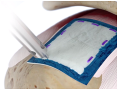 REGENETEN Bone Anchor Placement.png