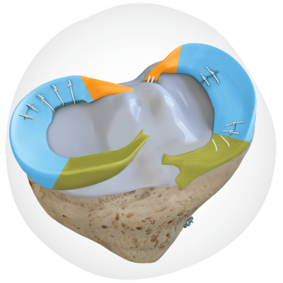 20250603_SPMPortfolio​ Meniscal-tear-anatomy-image.png