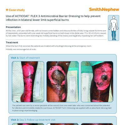 ACTICOAT FLEX 3 Burns Case Study 1