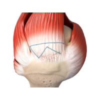 Tendon Seam Construct.png