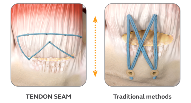 50975-V2-SHO-TENDON-SEAM-Webpage-assets-0926.png