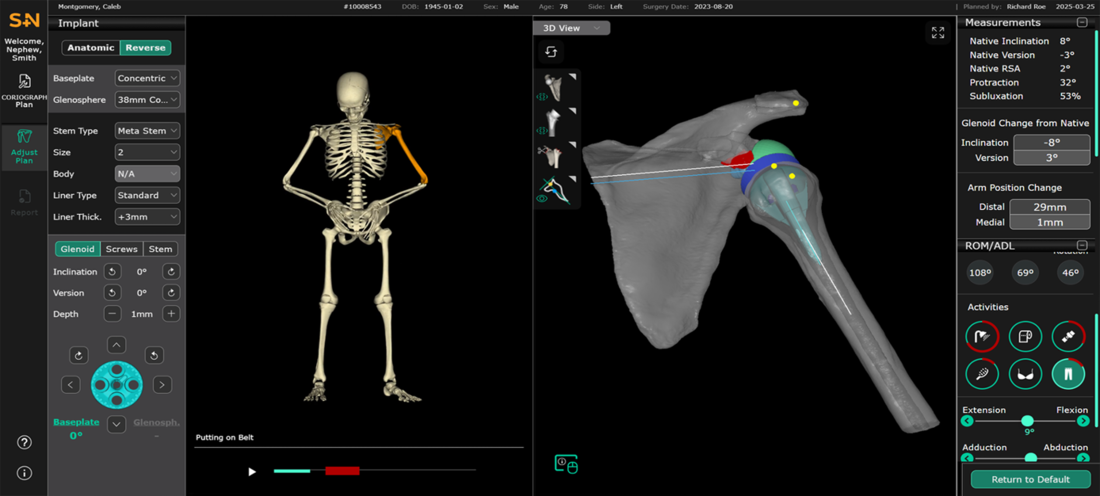 48688 V1 CORIOGRAPH Shoulder EiF Blog Graphic 1 0426.png