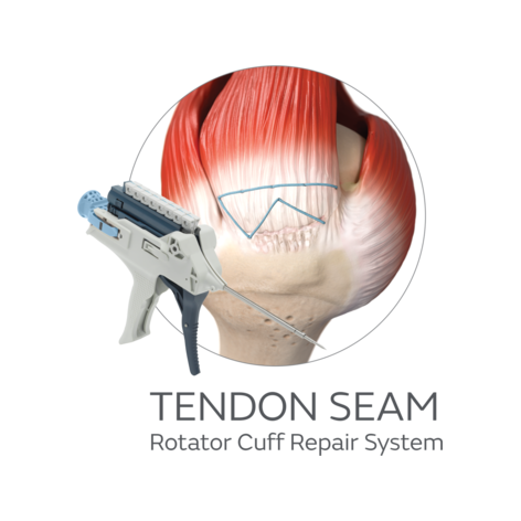 50777-15-V1-AOSSM-web-TENDONSEAM-1X1-0626.png