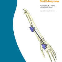 MAVERICK MINI Surgical Technique 