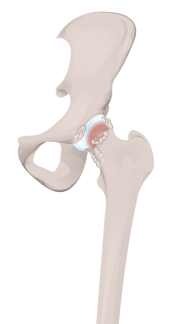 hip osteophytes.png