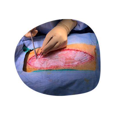 STRAVIX Umbilical Tissue Products | Smith+Nephew USA