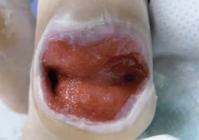 heelUlcer-sakata-august-12.jpg.jpg