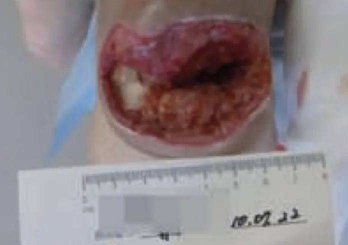 heelUlcer-sakata-july-22.jpg.jpg