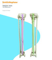 TRIGEN MAX Tibia Surgical Technique
