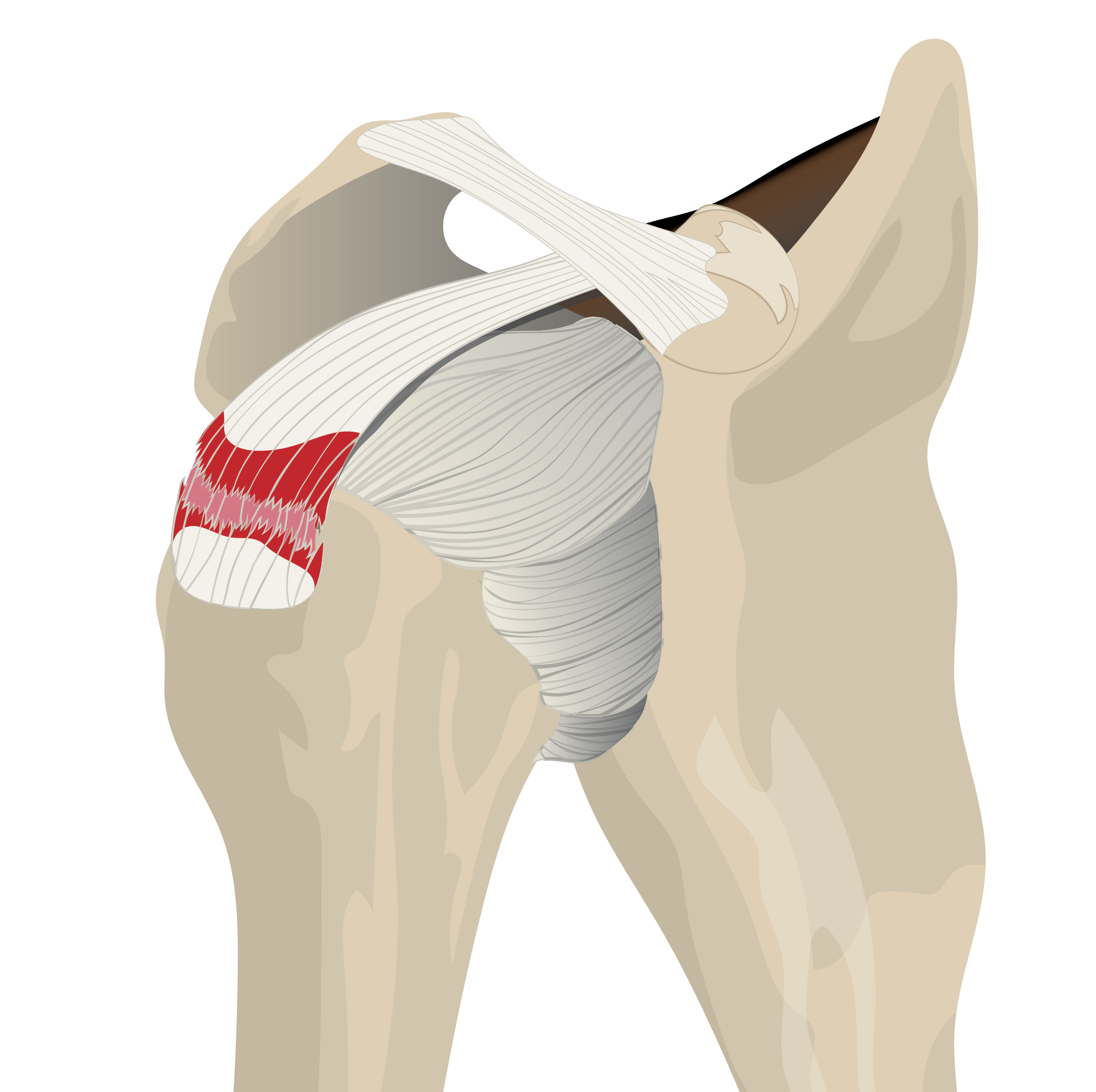 partial thickness tear.png