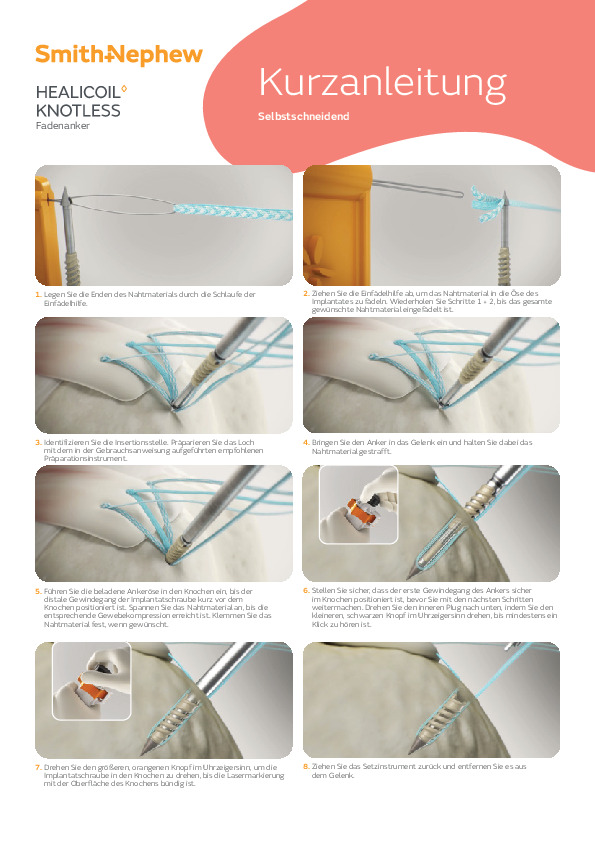 healicoil-knotless---ubersicht-op-schritte-selbst-schneidend--de---22198.pdf