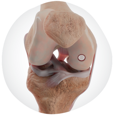 20250603_SPMPortfolio​ Cartilage-damage-anatomy-image.png