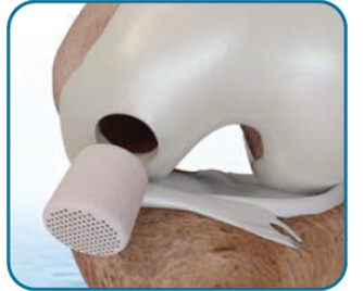 20250404_CartihealAgiliC_MoA1