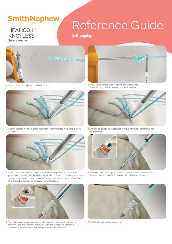 HEALICOIL Knotless Ref Guide Self Tapping