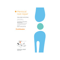 Meniscal Root Repair using a Single Tunnel Technique Guide