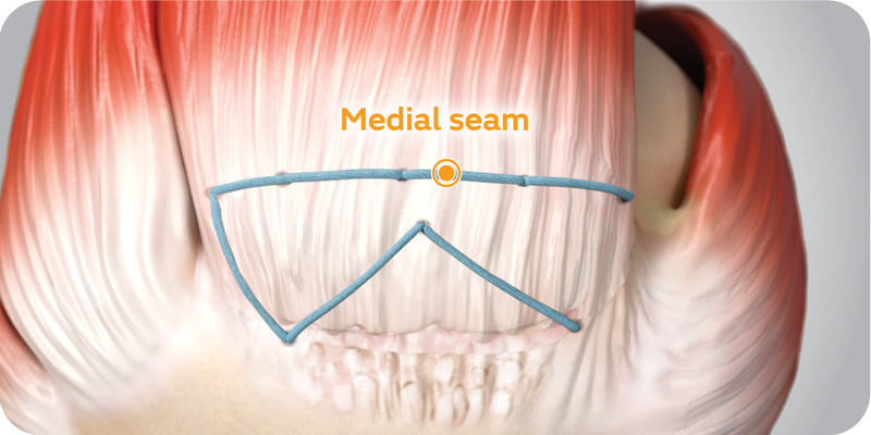 TENDON SEAM Flipbook 2 - Medial seam