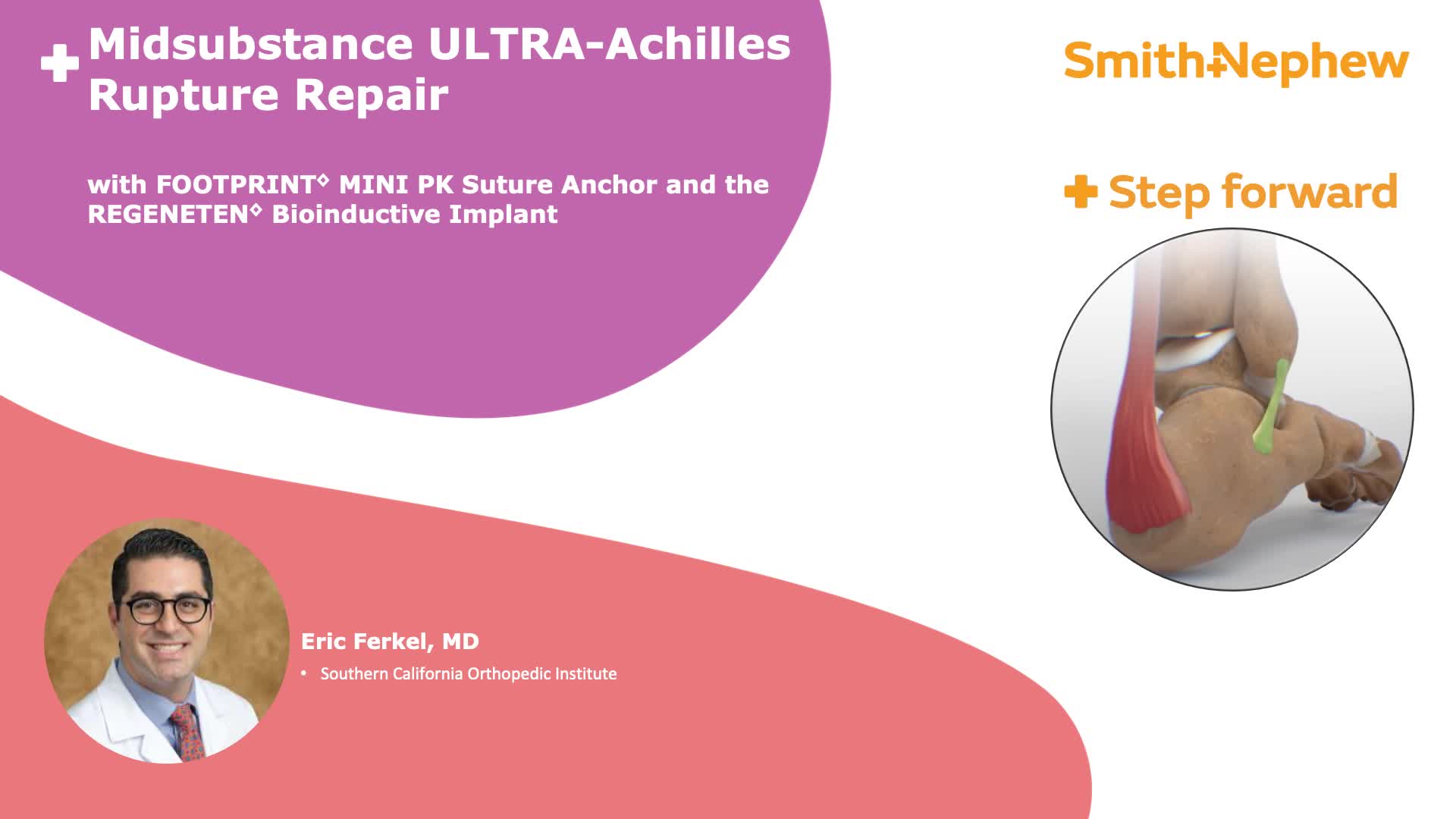 Midsubstance ULTRA-Achilles Rupture Repair with FOOTPRINT MINI and REGENETEN featuring Dr. Eric Ferkel