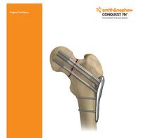 CONQUEST FN Surgical Technique