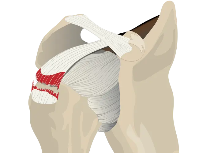 full thickness tear.png