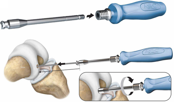 20250512_CARTIHEAL_SurgicalTechExcerpt