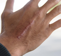 Scars