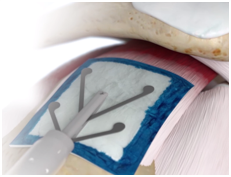 REGENETEN Deployment.png