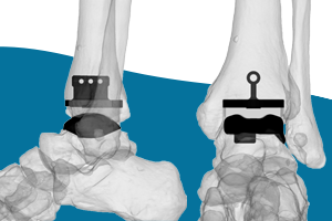 TOTAL ANKLE Final Implant Placement icon