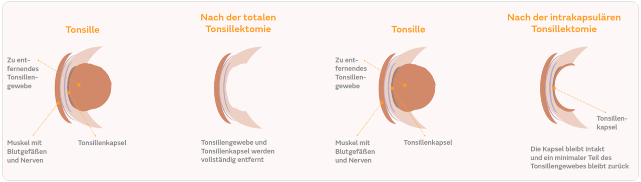 Mandeln und Adenoide entfernt