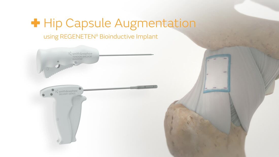 Hip Capsule Augmentation with REGENETEN Animation