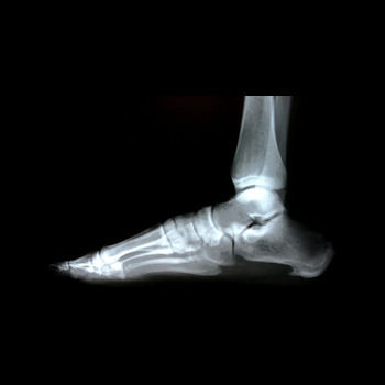 Foot X-ray-GettyImages-157180141-.jpg