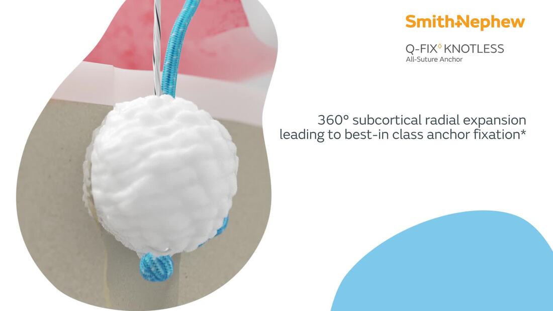 Q-FIX KNOTLESS All-Suture Anchor Highlight Reel