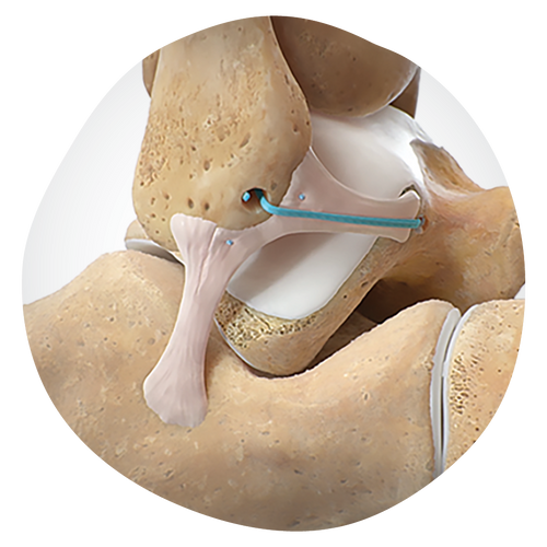 Q-FIX with Needles All-Suture Anchor for joint repair