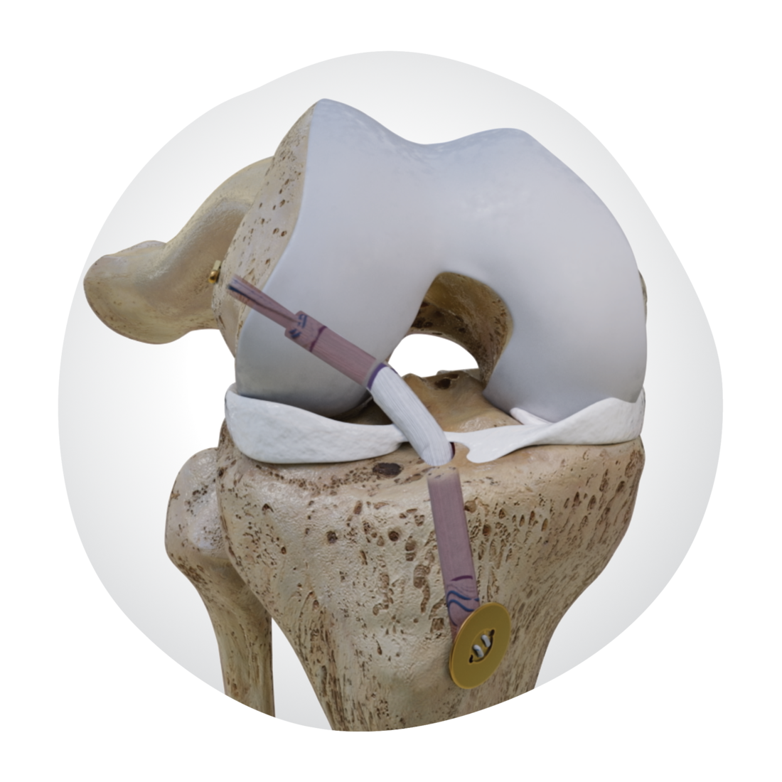 33747-V1-KNE-Ligament-Solutions.png