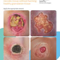 SANTYL Application Guide