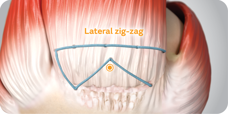 TENDON SEAM Flipbook 3 - Lateral zig-zag