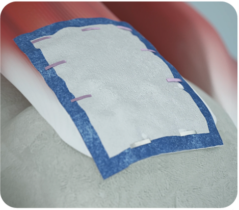 REGENETEN implant on RCR image from animation